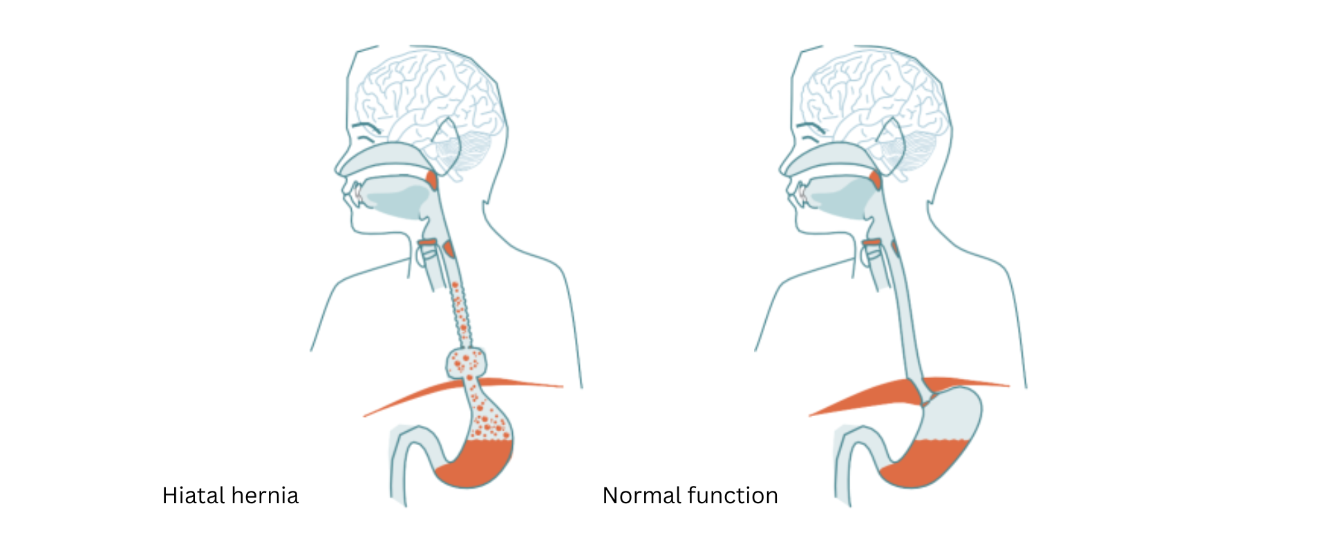 Hiatal hernia illustration